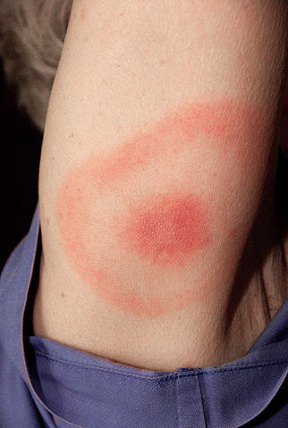 erythema migrains