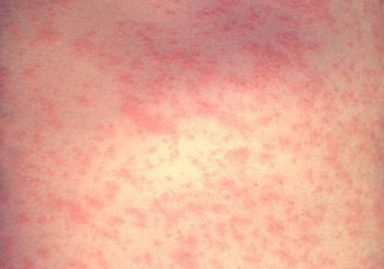 The rash on the skin of a measles patient. Photo credit: CDC/Dr. Heinz F. Eichenwald