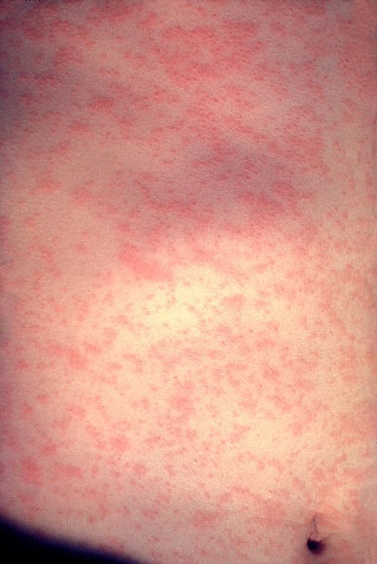 The rash on the skin of a measles patient. Photo credit: CDC/Dr. Heinz F. Eichenwald